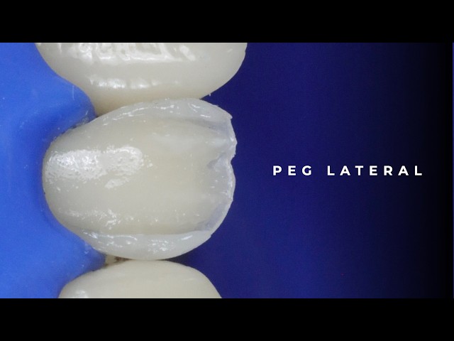 Natural Layering Technique for a Peg Lateral | Step-by-Step Composite
