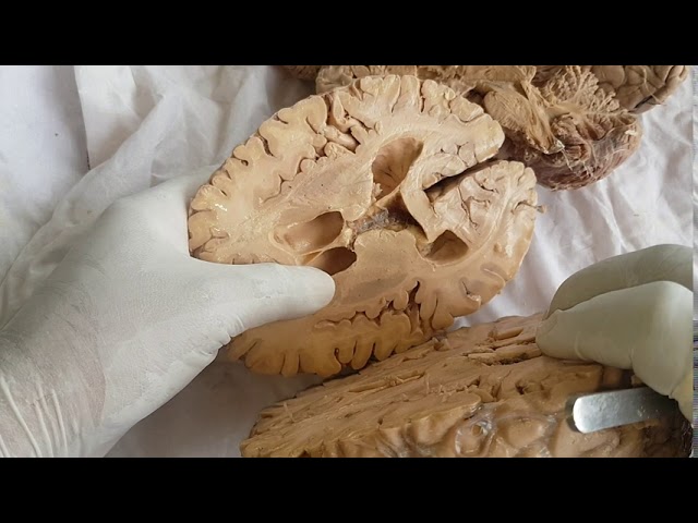 Sections of brain - gross anatomy