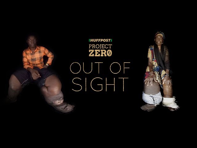 'Out Of Sight' 360-Degree Film Series: Elephantiasis
