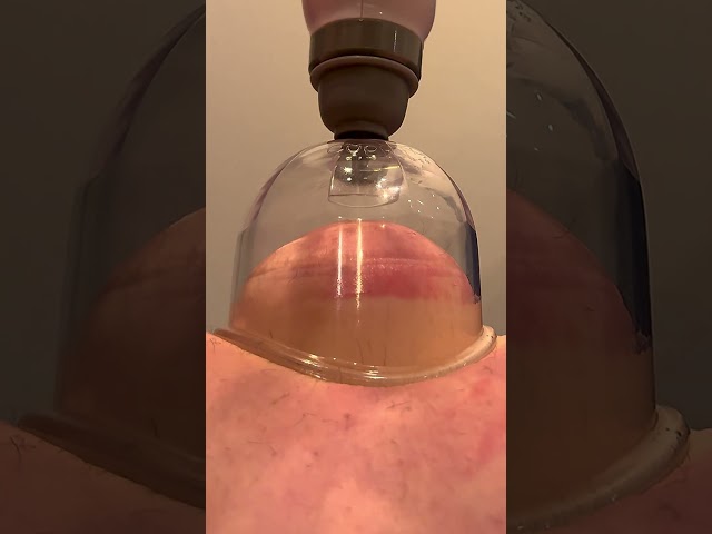 Cupping Therapy ASMR
