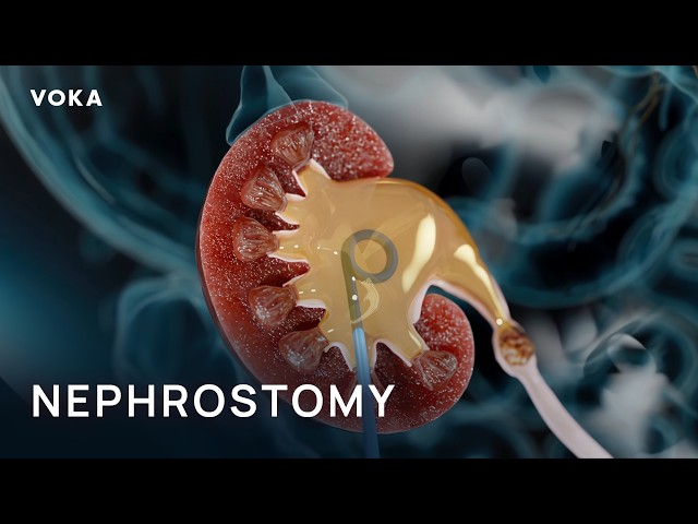 Nephrostomy Explained in 3D: Relieving a Blocked Kidney