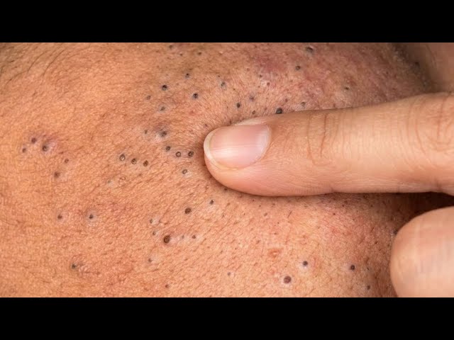 Deep Cleaning ASMR ✨New Elderly face steam facial Asghar Barber Shop | deep sac be spa blackheads 