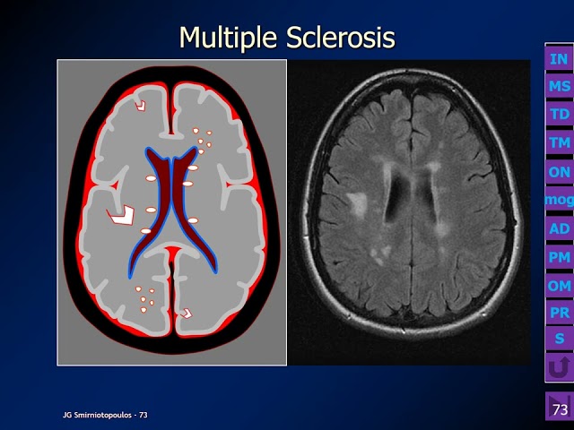 Making Sense of White Matter Disease - MedPix Video