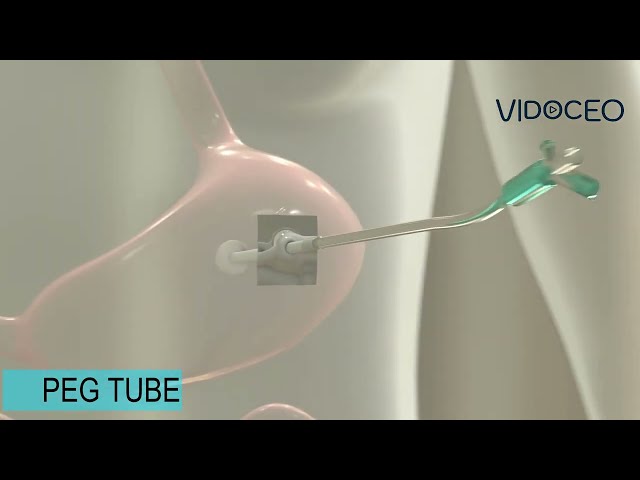 Percutaneous Endoscopic Gastrostomy (PEG) feeding tube animated explanation