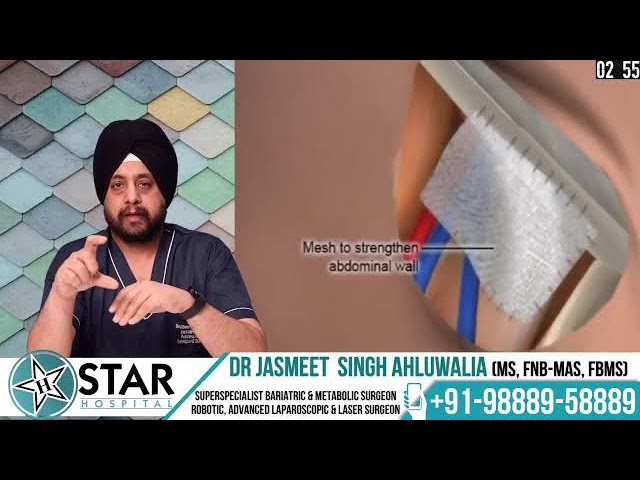 Inguinal Hernia: Causes, Symptoms, Treatment & Prevention | Hindi | Star Hospital Jalandhar Punjab