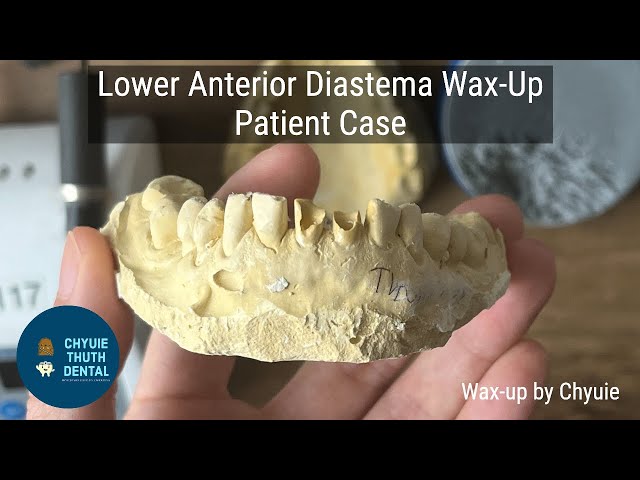 [ChyuieThuth] Lower Anterior Diastema Wax Up - Patient Case