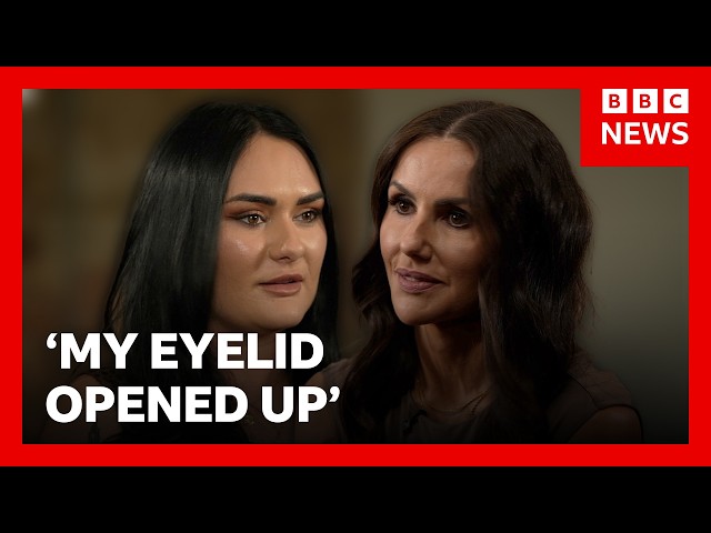 Warnings from women over cheap 'bleph' eyelid surgery | BBC News