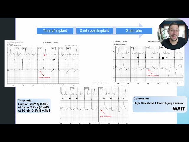 PSA Testing During Pacemaker and ICD Lead Implantation