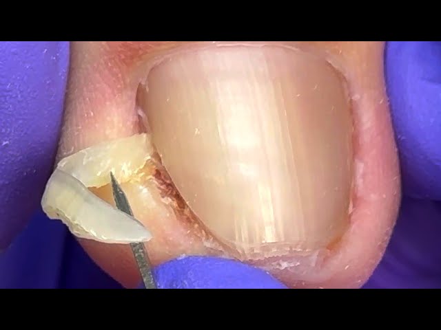 Solve the problem of ingrown nails for patients, dig out the small hooks【Doctor Liu Pedicure】