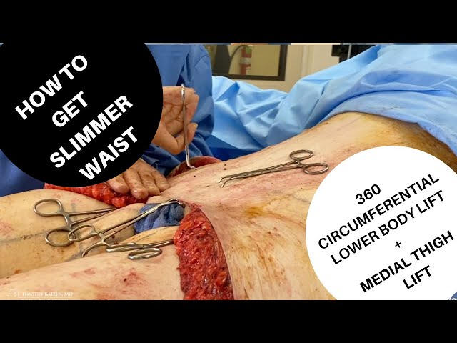 (360 Circumferential Body Lift) Lost 160 pounds and want to get rid of extra skin and fat!