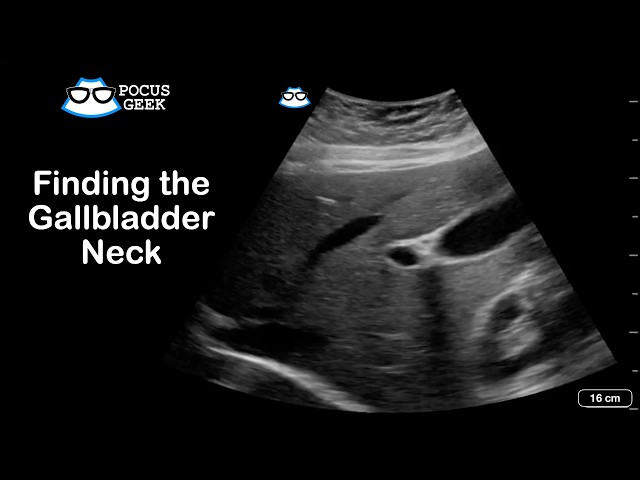 Ultrasound Tip: Finding the Hidden Gallbladder Neck