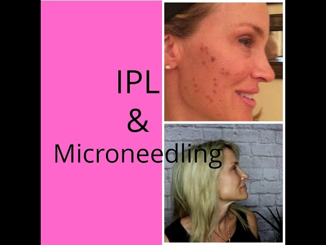 IPL and microneedling