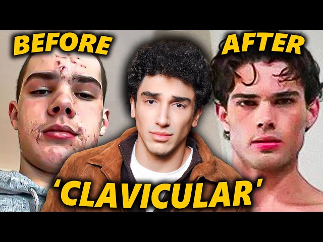 Clavicular: The Internet's Prettiest Incel