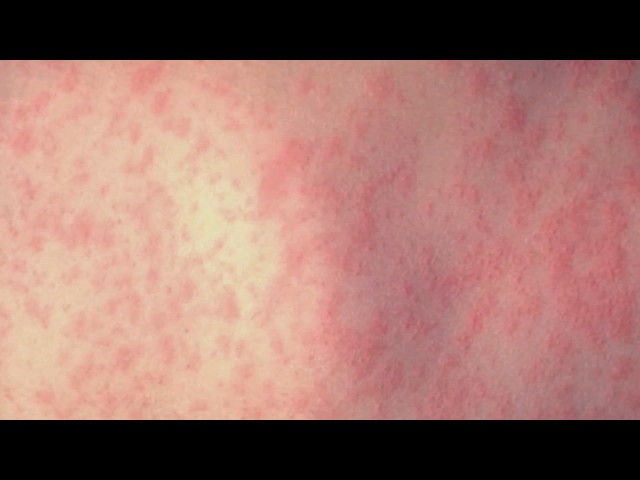 Pennsylvania surpasses 900 measles cases as outbreak continues to spread