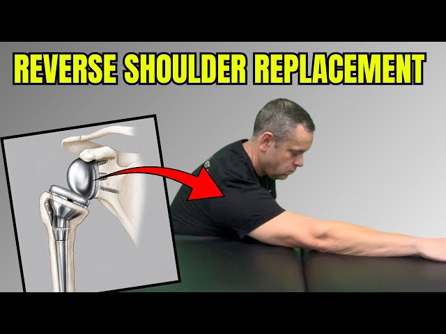Reverse Total Shoulder Replacement: First 2 Weeks of Therapy Exercises