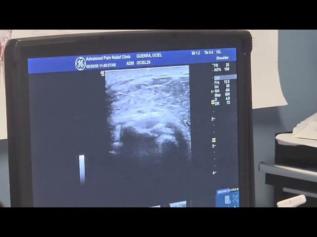 INJECTION OF THE SUBSCAPULARIS AND MIDDLE GLENOHUMURAL LIGAMENT 