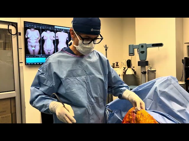You have to watch this Insane Tummy Tuck with Liposuction transformation | Six Surgery
