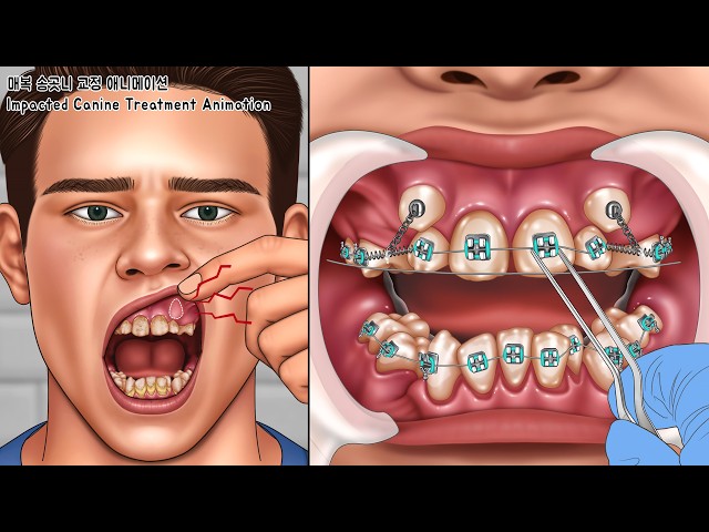 ASMR Impacted Canine Treatment | Tartar Removal & Teeth Scaling | Dental Care Animation