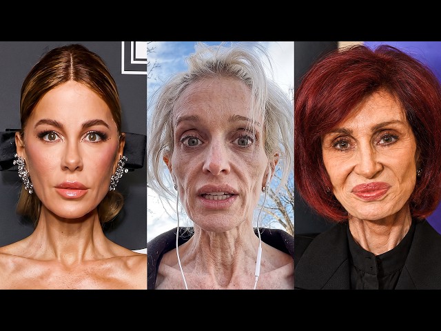14 British Celebs Suffering From Ozempic Face | Before & After Photos 2026