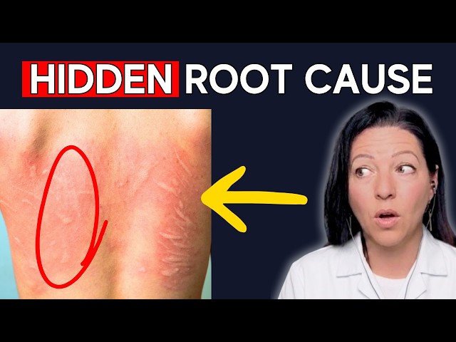 Why Your Chronic Hives Won't Go Away (Dermatographia, Urticaria)