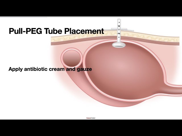 HCC 1475-37-PEG