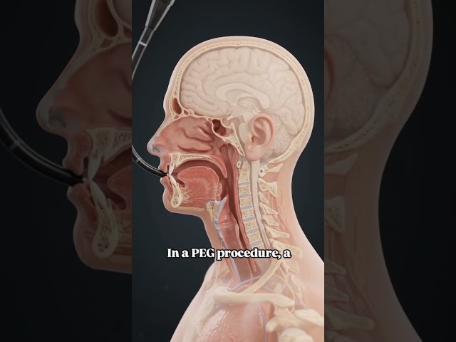 How a PEG Feeding Tube Works 🩺 #shorts #medical