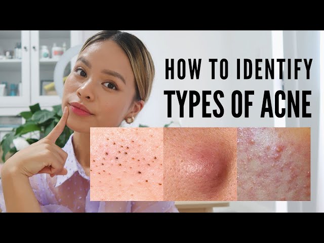 How to treat EVERY type of acne (With Pictures)