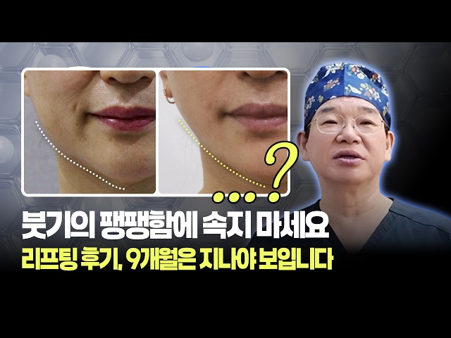 9 Months Post-Lifting: Real Results, Not Just Swelling | Combination Procedure + Stem Cells | Bon...