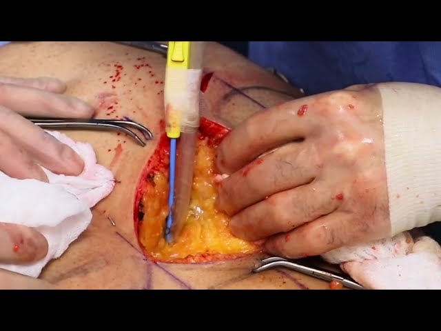 Partial Buttock Amputation for Silicone Injections Removal (Permanent Filler Removal)