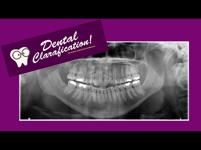 Anatomical Landmarks Found in a Panoramic Radiograph
