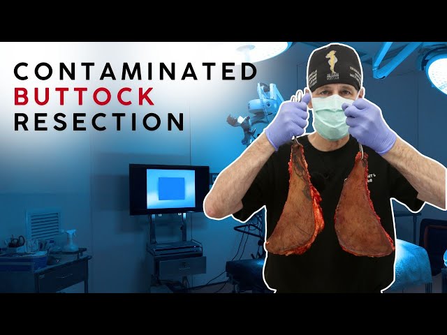 (Surgical Video) Silicone Contaminated Buttock Causes Patient Alligator Skin and Pain