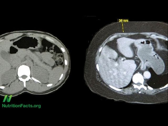 Metabolic Syndrome and Plant-Based Diets