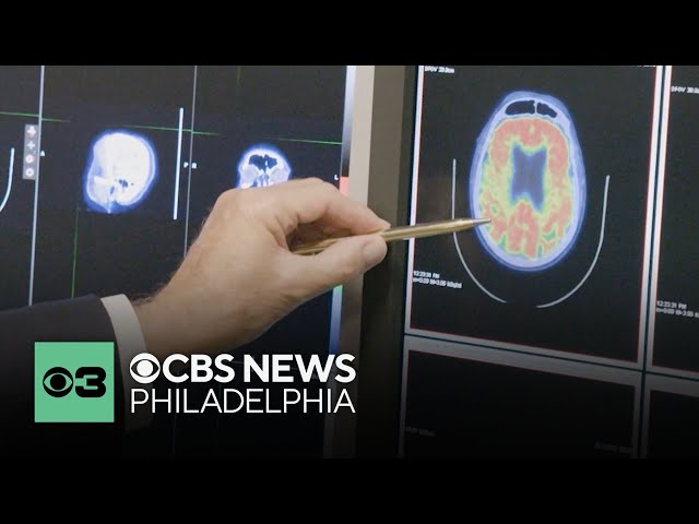 Potentially dangerous brain condition cases on rise and doctors don't know why