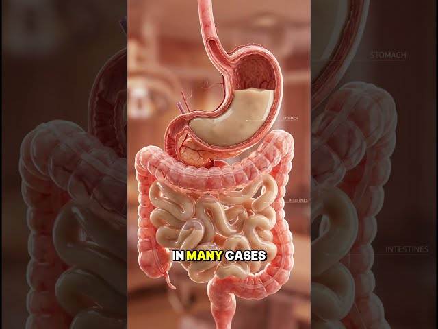 How Doctors Insert a PEG Tube into the Stomach After a Stroke