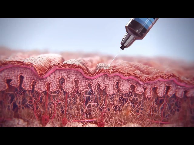 Aging Process of Skin: Dermal Injections to stimulate production of Collagen to rejuvenate skin