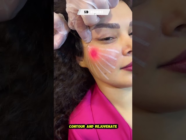 🔥 Endolift: Non-Surgical Facial Lifting with Instant & Long-Lasting Results