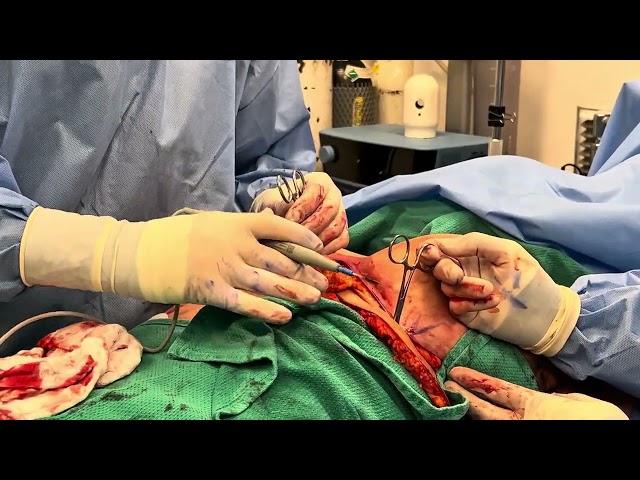 Reverse tummy tuck with mini armlift! All in one surgery