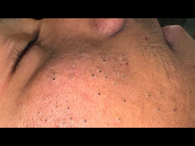 [ASMR] Facial Care Routine for Acne & Blackheads | Skincare Routine