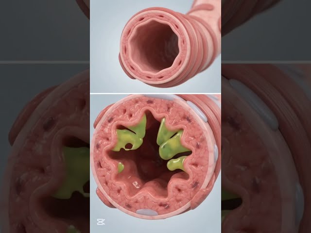 Asthma Explained