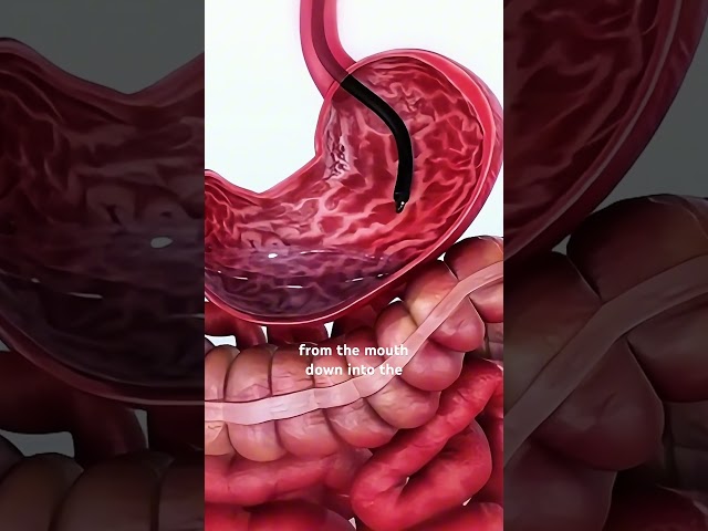 How PEG Tube Procedure Is Done(3D animation) #music #motivation #epic #like