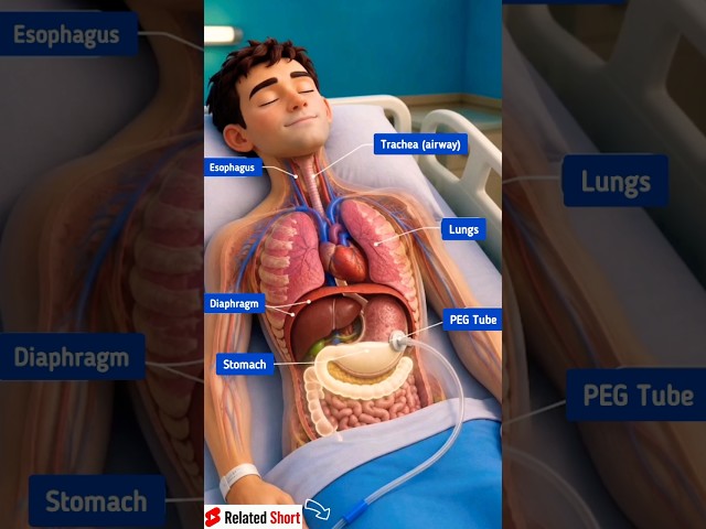 PEG | Feeding tube for patients 3d infographic