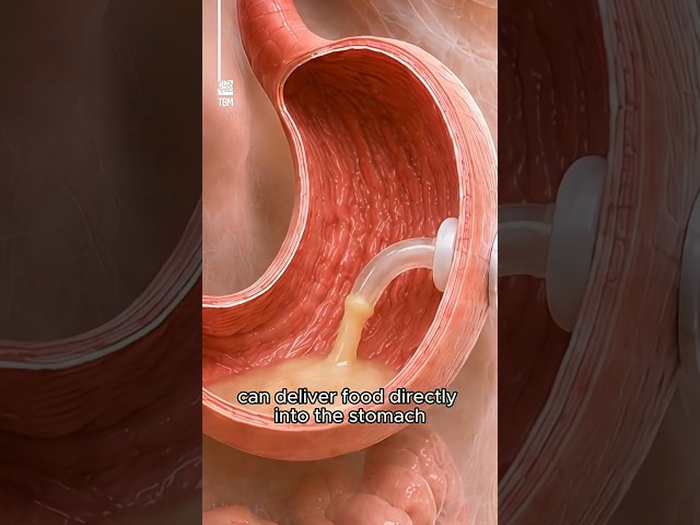 A Stomach Feeding Tube