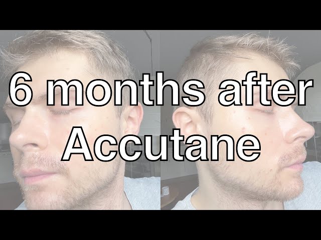 Update: 6 Months After Accutane