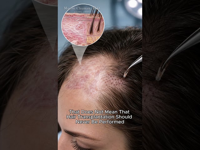 Can Hair Transplants Work in Scarring Alopecia? #hairtransplant