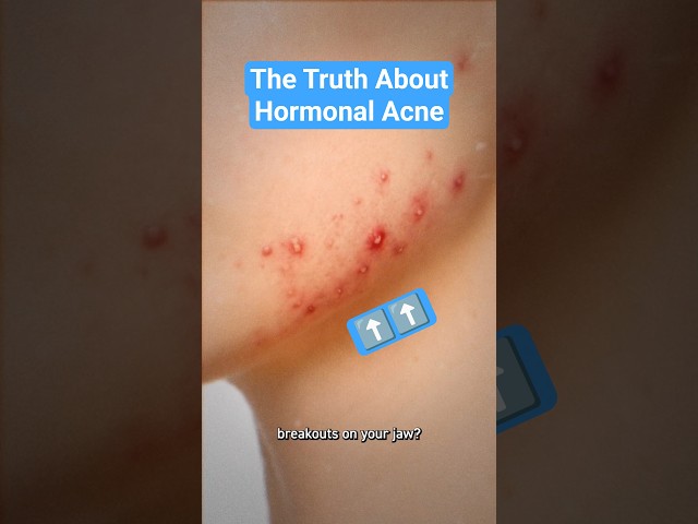 The Truth About Hormonal Acne