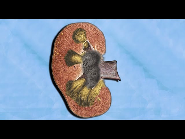 A Student Drank 2 Gallons Coffee. This Is What Happened To His Kidneys.