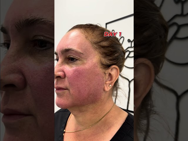 What to expect after your HALO laser treatment