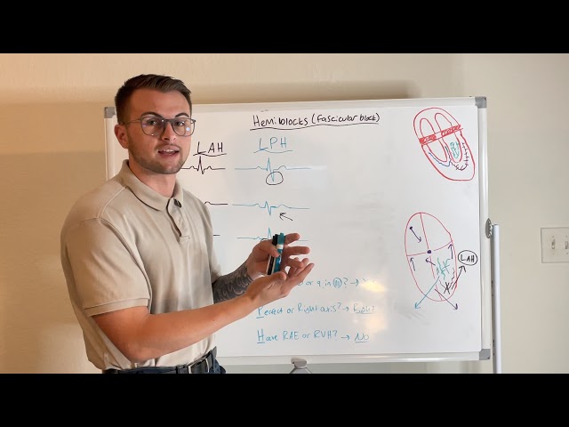 EKG Series: Left Anterior and Left Posterior Hemiblocks (Fascicular Blocks)