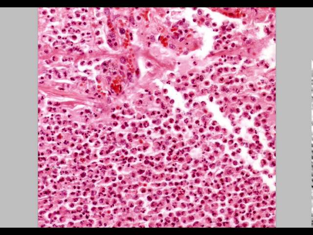 Histology- Acute vs Chronic Inflammation