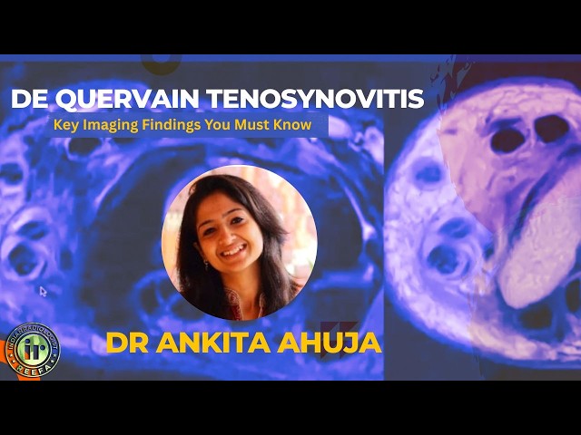 Ankita Ahuja | De Quervain Tenosynovitis : Key Imaging Findings You Must Know